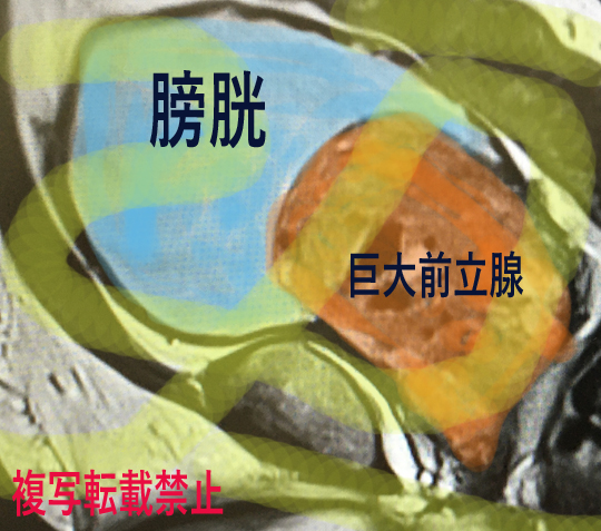店主の巨大前立腺