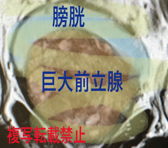 巨大前立腺 アクアブレーション手術
